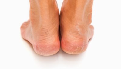 פטרת בכף הרגל