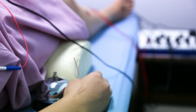 acupuncture דיקור סיני