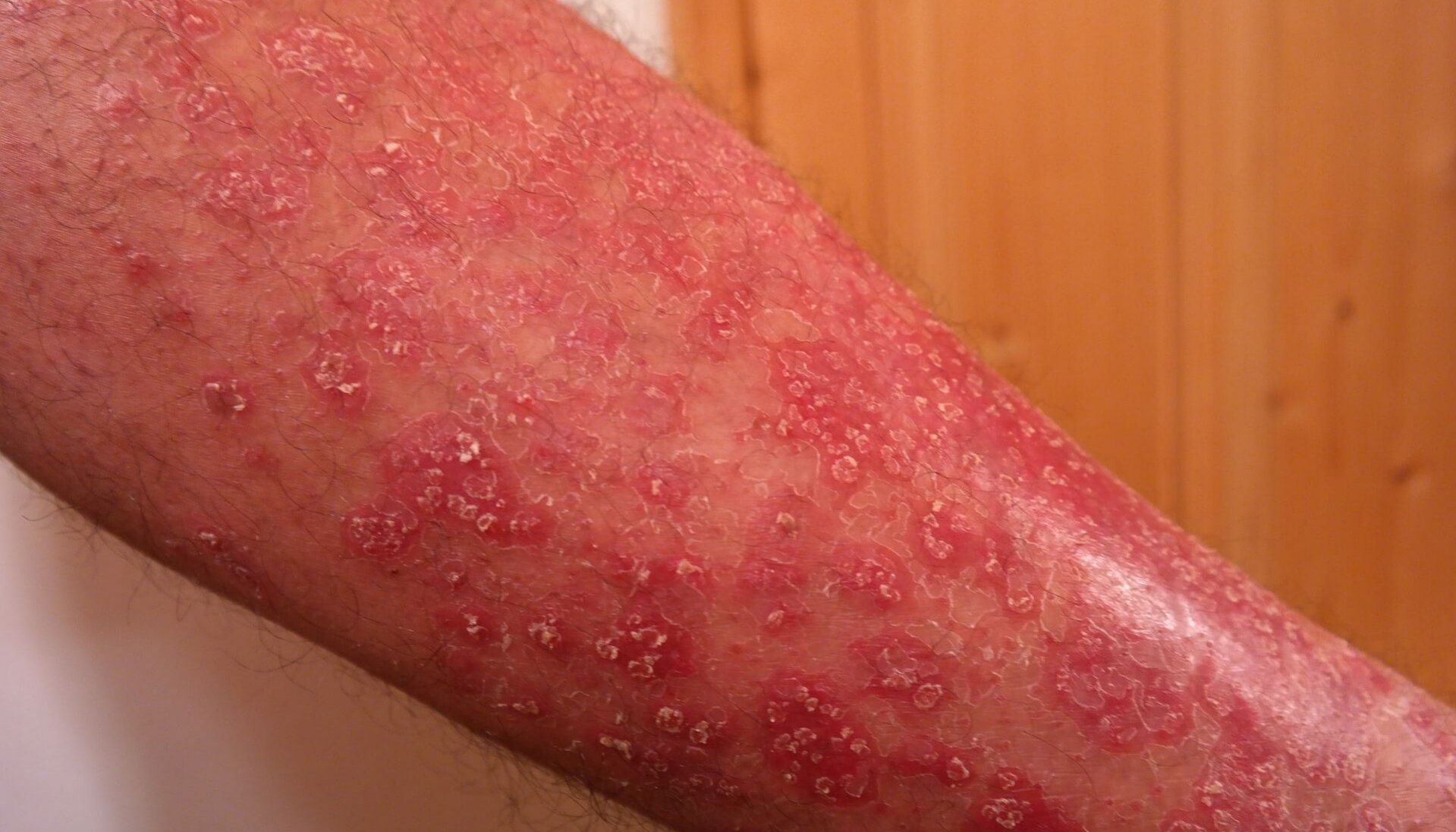 אסטמה של העור